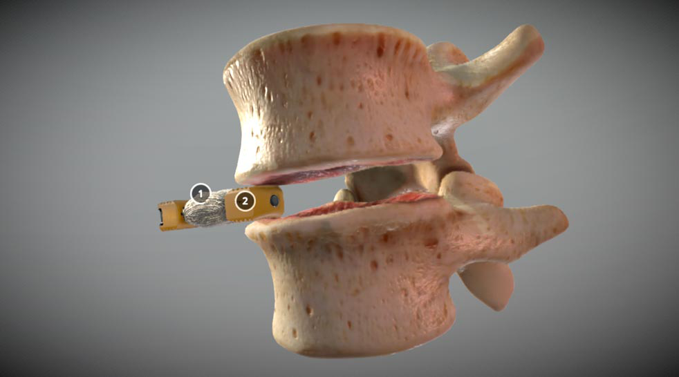 Duo™ Lumbar Interbody Fusion System
