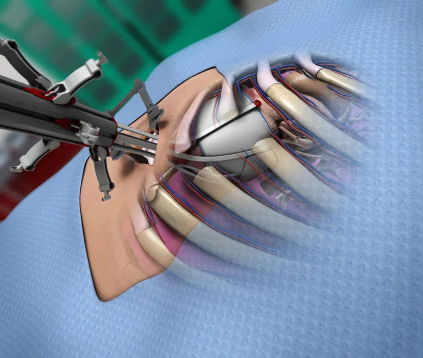 Detailed Medical Illustration of of Mardil Medical's VenTouch Device by Ghost Medical. The VenTouch device is a triad targeted ventricular reshaping system used to treat type IIIB Functional Mitral Valve Regurgitation.
